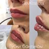 Контурная пластика губ