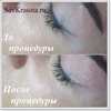 Лазерное удаление стрелок