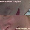 Коагуляция сосудов