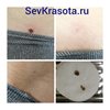 Удаление доброкачественных новообразований