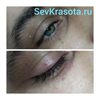 Удаление папиллом на веках