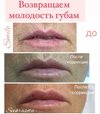 Возвращаем молодость губам