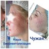 Наша биоревитализация/Чужая