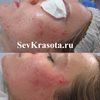 Чистка лица 