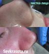 Чистка лица