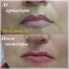 Лазерное удаление татуажа 