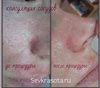 Удаление сосудистых образований