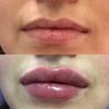 Увеличение губ филлером на основе гиалуроновой кислоты